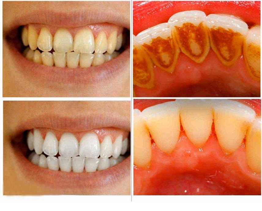 بلیچینگ کم آسیب‌ترین روش‌ سفید کردن است