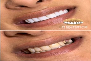 ونیر کامپوزیت چگونه به داشتن لبخند زیبا کمک می‌کند