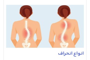 اسکولیوز یا انحراف ستون فقرات